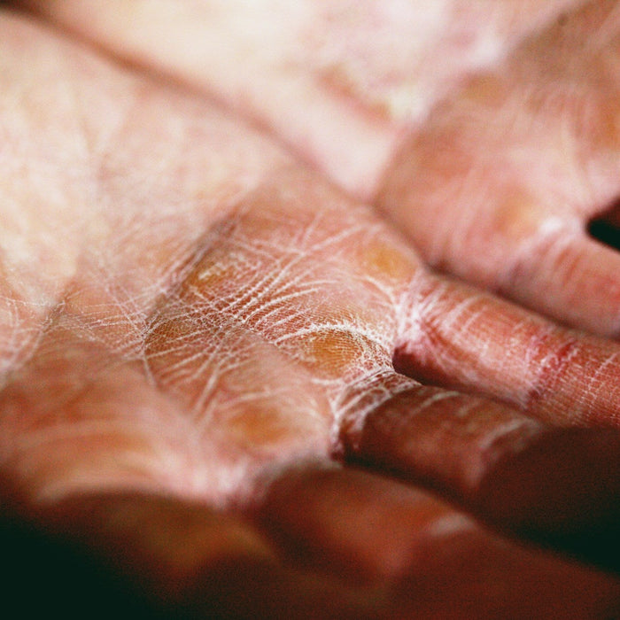 dry skin