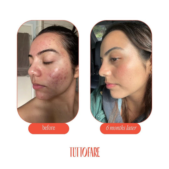 Before and after photos showing skin improvement after using Roman Blue Tallow Balm - 70g by Tuttofare over six months