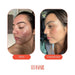 Before and after photos showing skin improvement after using Roman Blue Tallow Balm - 70g by Tuttofare over six months